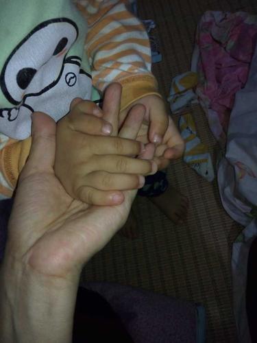 宝宝先天六指,什么时候手术最佳?