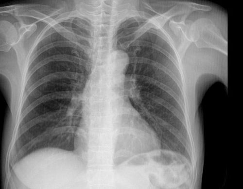 年年体检没问题,为何突然就查出来肺癌晚期了?两点原因需要避免