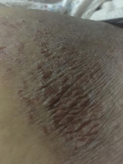 在大腿内侧这是股藓还是湿疹