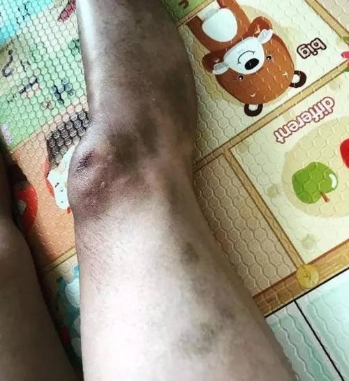 梁烈唯被车撞飞惊现"尸斑脚" 考虑向萧正楠求婚!翠如:女仔主动冇所谓