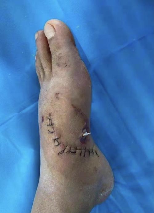 神经吻合 克氏针内固定手术治疗左足内侧电锯割裂伤