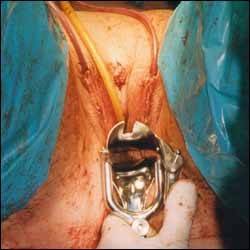 《变性手术男变女过程》场面恶心慎入!