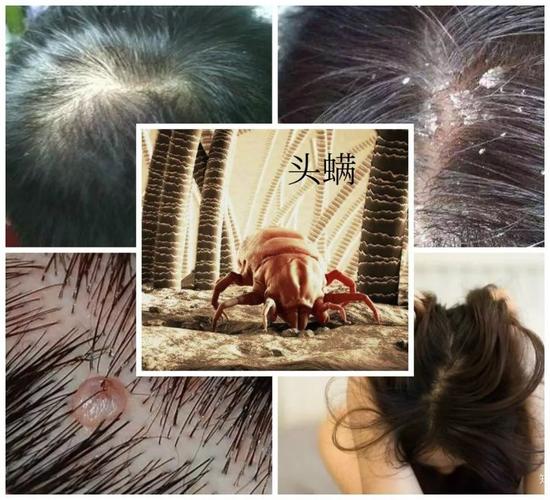 头皮上竟有8000支螨虫!难怪又油又痒,网红迷迭香,3秒止痒,迅速驱螨