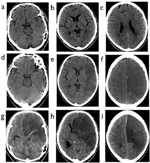 脑梗死患者的头部ct,你真的会看吗?丨实战读片