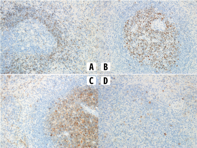 对一例内脏利什曼病的学习及思考