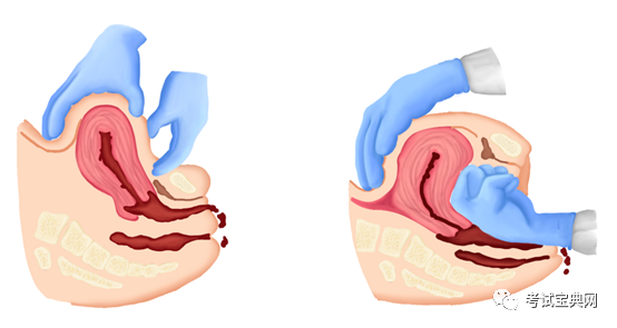 腹部子宫按摩和腹部-阴道子宫按摩