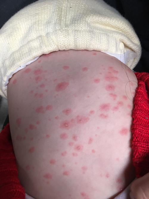 请问一下,我家宝宝这个是水痘还是病毒性皮疹?