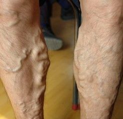 临床可见的还有食管胃底静脉曲张,精索静脉曲张及腹壁静脉曲张等等