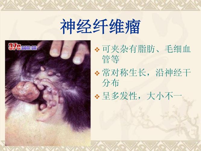 常见体表肿瘤ppt