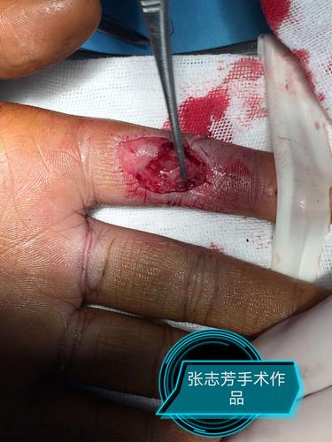 指动脉顺行皮瓣修复手指指腹缺损