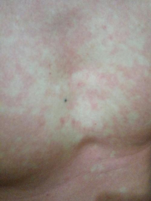 以前喝酒了都不会这样.今晚喝了10瓶啤酒就身上好多白点,手指按一下