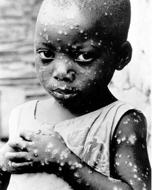 祸害三千多年的天花病毒,致死率30%!我们是如何找到有效药的?