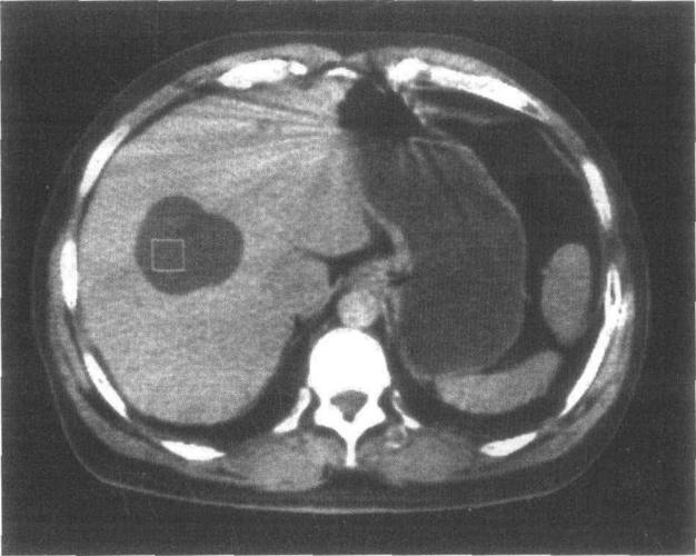 肝囊肿-腹部ct诊断-医学