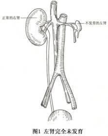 未发育的肾脏无肾实质,肾盂和肾蒂残迹,输尿管为索状纤