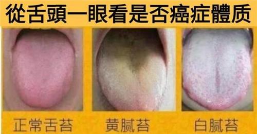 从舌头一眼看是否癌症体质,癌细胞最怕1种碱性食物,常吃防癌