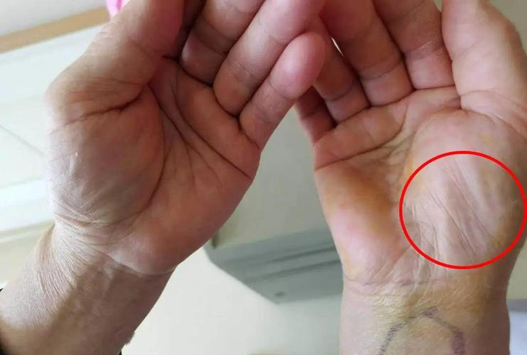 女子出现手麻,拖延1年后就医,手掌这地方已"瘪"掉!年轻人易中招