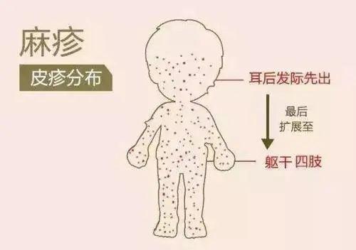 幼儿急疹风疹麻疹湿疹猩红热如何分辨护理全在这里了