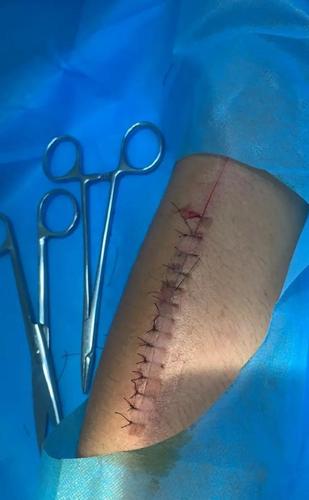 货车司机自残求复磅,当事人发声,伤口14针