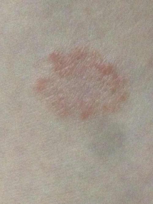 请问皮肤上这种是皮炎湿疹还是什么癣?