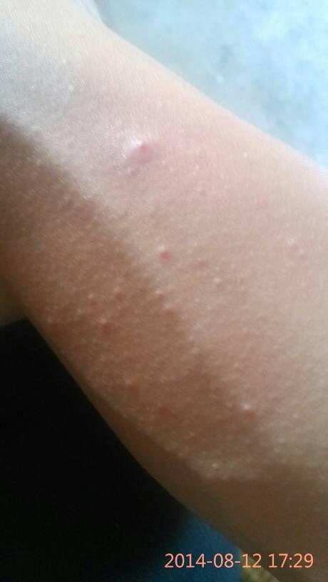 问:手臂上有这些,请问是湿疹还是毛囊炎?