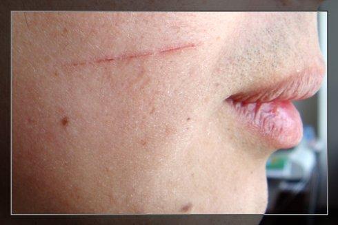 脸上这疤[2008-12-10]