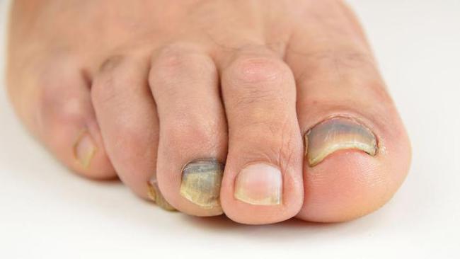 灰指甲告别无效治疗退休老中医一招根除灰指甲千万患者已康复