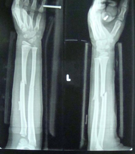 7岁女童尺桡骨双骨折,对位不佳,如何治疗?