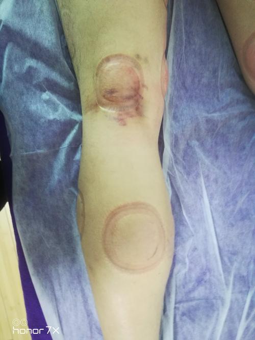 拔罐疗法可以逐寒祛湿,疏通经络,行