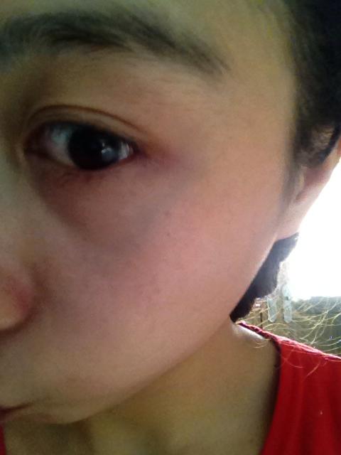 眼睛下面有条青色血管怎么回事?有去掉的方法吗?求赐教