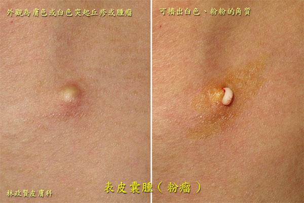 图谱:粉瘤(表皮囊肿)