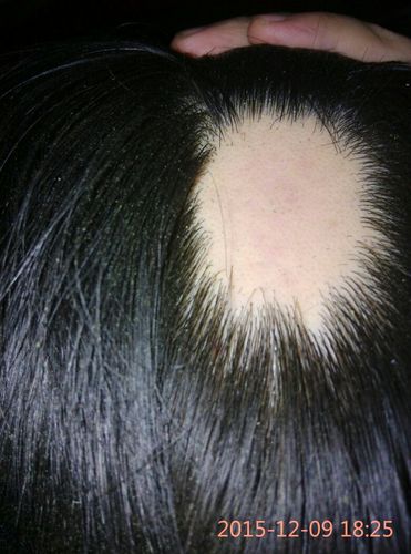 斑秃位置擦生姜片,长出了一点细头发,还需要擦生姜吗?