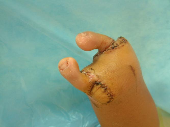 全手缺损足趾移植再造手