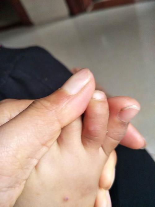 大神帮我看看小孩这个是湿疹还是手足口病,离县城医院