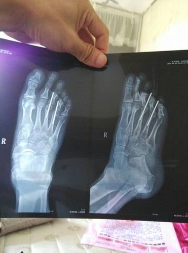 40多天了,今天去医院复查,露出来的克氏针却不能拔出来,到了下个月18