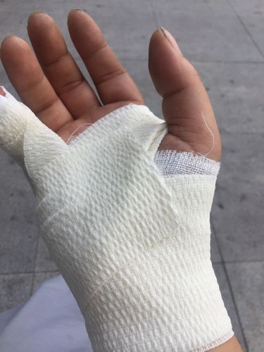 小木手指肌腱断裂去骨科医院医生让固定住缠着纱布可是过去半个月了没