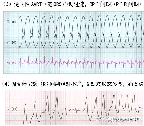预激综合征心电图少见表现与诊断思路