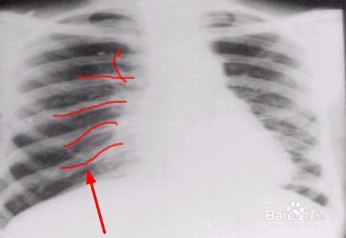 支气管扩张有什么表现?该怎样治疗?