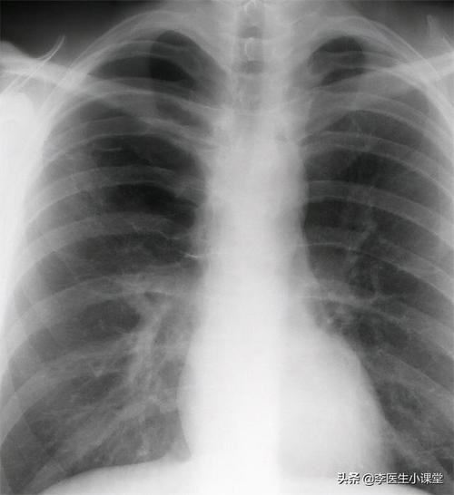 x线 x光 x光片 x线 640_699