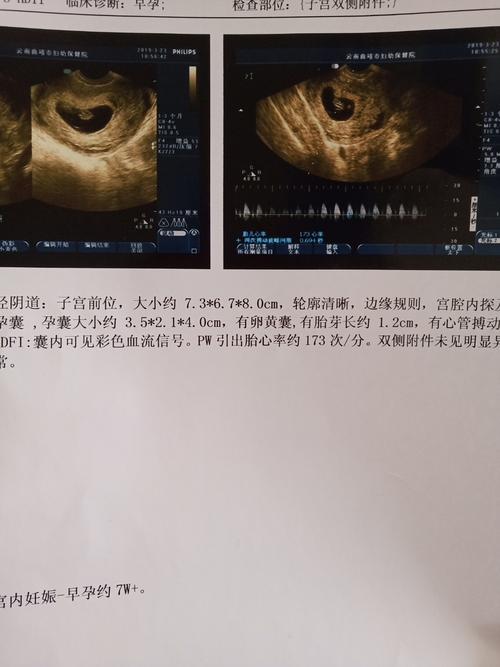 我这个孕囊应该是椭圆形吗