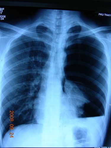 气胸的主要类型有那些?