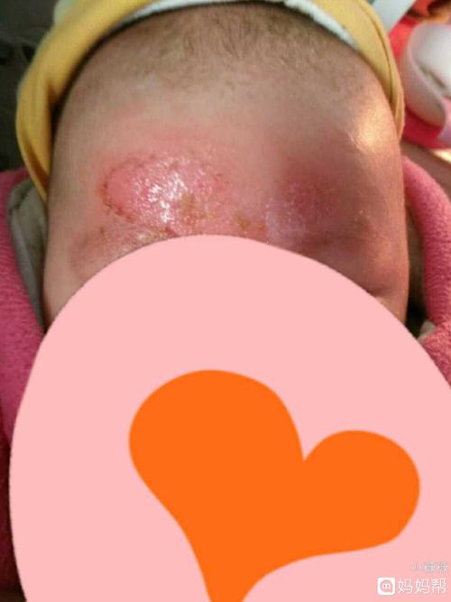 宝宝奶疹终于快好了,把我心疼的,后来终于买对药膏了快好了