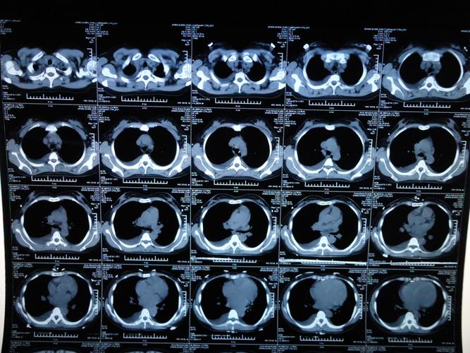 帮忙看看这ct片!