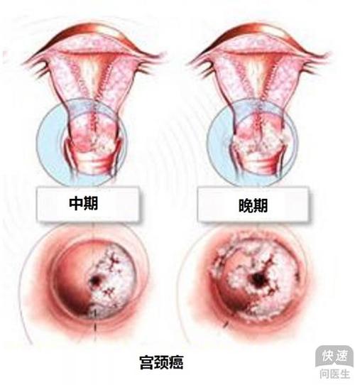 宫颈癌中晚期能治好吗?