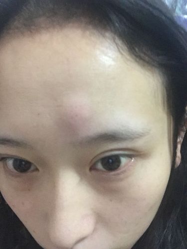 额头刚刚忽然一下子冒出个包!摸起来还疼!感觉是我摸大的!