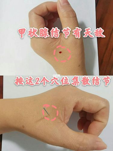 甲状腺_止痛