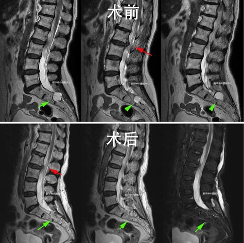 86岁骶管囊肿合并腰突肛门会阴剧痛如何处理