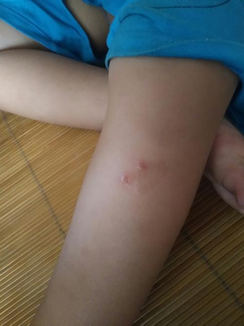 亲们帮忙看一下这伤口是狗咬的吗