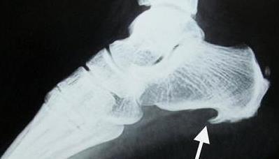 骨刺是骨头长刺儿了吗