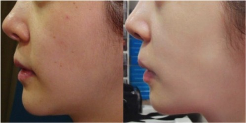 水光针注射效果好吗水光针注射前后对比图