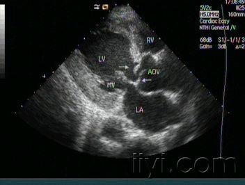 【讨论】主动脉瓣声像图 - 超声医学讨论版 - 爱爱医